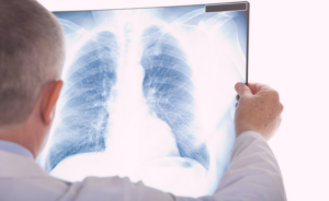 causas e prognostico do câncer de pulmão